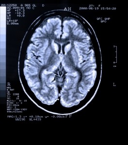 traumatic-brain-injury-attorney