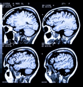 brain-injury-nj-attorney-anthony-carbone