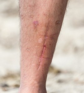 preexisting-injury-in-a-personal-injury-case