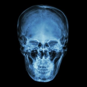brain-injuries-in-accident-claims
