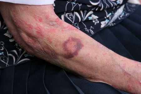 Signs Of Nursing Home Abuse Bed Sores Anthony Carbone Pc New Jersey Personal Injury Lawyer