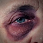 Elderly person with black eye suffering from elderly abuse