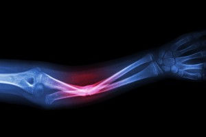 broken bones accidential injuries series anthony carbone
